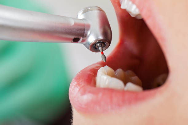 Best Emergency Dental Extractions in Merced, CA